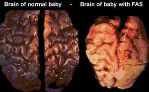 הנזק ש"הקוברה השחורה" מסוגלת לגרום למוח התינוק