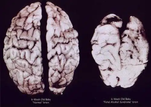 מוח של תינוק רגיל בן 6 שבועות (שמאל) ומוח של תינוק עם תסמונת אלכוהול עוברית בגיל 6 שבועות (ימין)