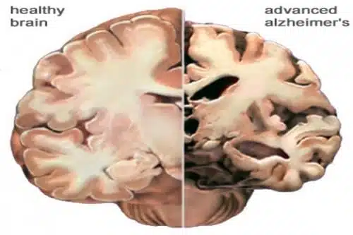 מוח בריא לעומת מוח בשלב מתקדם של אלצהיימר