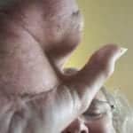 כף ידו של מרטין גרינפלד - קטוע אצבעות
