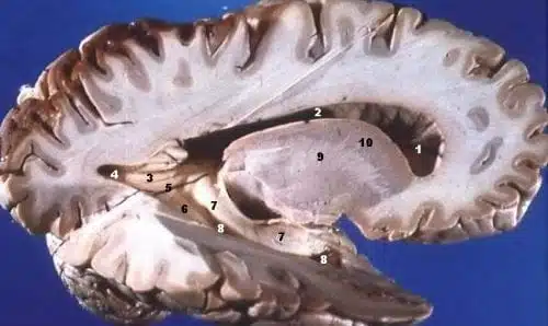 מבט תיכון על חתך במישור החיצי של המוח. בתמונה ניכרים הבדלי הצבעים בין החומר האפור בשוליים לחומר הלבן במרבית החתך