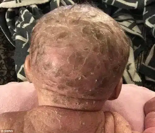 תינוק חלים בעזרת שמן קנאביס - מחלת עור