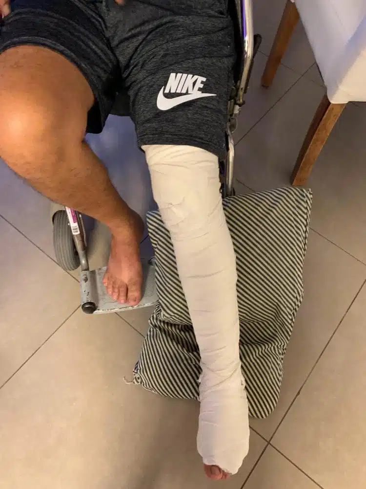 רגל שבורה מגובסת של מטופל קנאביס רפואי