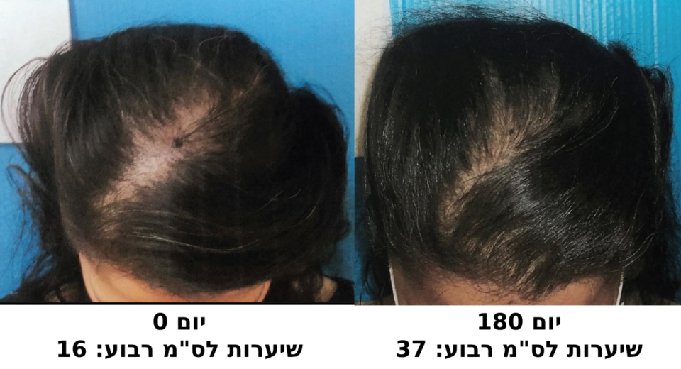 תמונות לפני ואחרי הטיפול בספריי הקנאביס של אחת הנבדקות במחקר (International Journal of Trichology, 2023)
